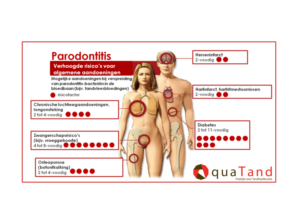 parodontitis ziekten lichaam